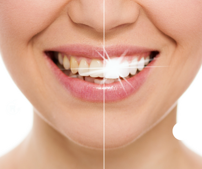 L'importance d'une brosse à dents électrique pour des gencives saines et des dents blanches